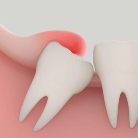 Dấu Hiệu Nhận Biết Răng Khôn Mọc Lệch Từ Sớm
