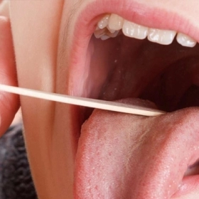 Dấu Hiệu Sùi Mào Gà Ở Họng Bạn Không Nên Bỏ Qua