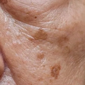 Dày Sừng Ánh Sáng: Nguyên Nhân, Triệu Chứng và Cách Điều Trị