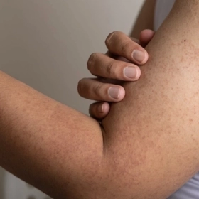 Dày Sừng Nang Lông: Nguyên Nhân, Triệu Chứng Và Giải Pháp Điều Trị