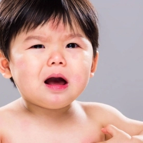 Dị Ứng Đạm Bò Là Gì? Nguyên Nhân, Dấu Hiệu Và Cách Điều Trị