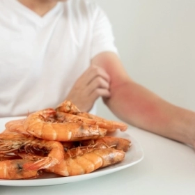 Dị Ứng Hải Sản Là Gì? Nguyên Nhân, Dấu Hiệu Và Cách Xử Trí 