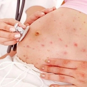 Dị Ứng Thai Kỳ Là Gì? Nguyên Nhân Và Cách Nhận Biết