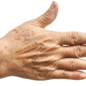 Đồi Mồi Là Gì? Nguyên Nhân, Dấu Hiệu Và Cách Điều Trị Hiệu Quả