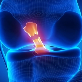 Đứt Dây Chằng: Dấu Hiệu, Mức Độ Và Cách Điều Trị