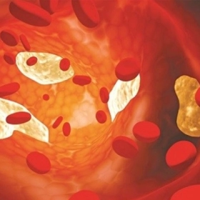 Enlicitide Decanoate Là Gì? Thuốc Giúp Giảm LDL Cholesterol