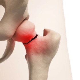 Gãy Cổ Xương Đùi: Nguyên Nhân, Triệu Chứng Và Cách Điều Trị Hiệu Quả