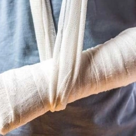 Gãy Xương: Dấu Hiệu, Cách Sơ Cứu Và Quy Trình Điều Trị