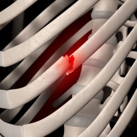 Gãy Xương Sườn: Nguyên Nhân, Triệu Chứng Và Cách Điều Trị