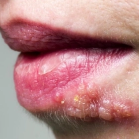 Giời Leo Ở Miệng Bao Lâu Thì Khỏi? Cách Giảm Đau Và Điều Trị Nhanh Nhất