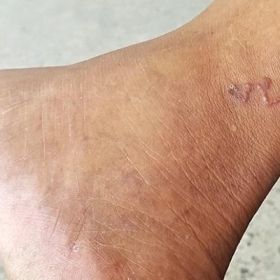 Giun Đầu Gai Là Gì? Nguyên Nhân, Triệu Chứng Và Cách Điều Trị