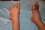 Gout Gout