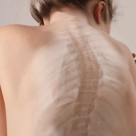 Gù Lưng: Nguyên Nhân, Triệu Chứng Và Giải Pháp