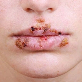 Hạ Cam Mềm Là Gì? Nguyên Nhân, Triệu Chứng Và Cách Điều Trị