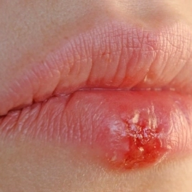Herpes môi: Nguyên nhân, dấu hiệu và các phương pháp điều trị