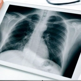Hình Ảnh Phổi Trắng Trên X-Quang: Cảnh Báo Bệnh Gì?