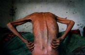 HIV/AIDS HIV/AIDS