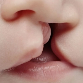 Hội Chứng DiGeorge Là Gì? Nguyên Nhân, Triệu Chứng Và Cách Điều Trị