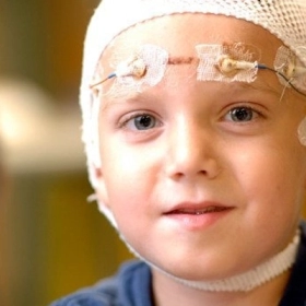 Hội chứng Lennox - Gastaut: Dấu hiệu và cách điều trị