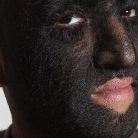 Hội Chứng Người Sói Là Gì? Nguyên Nhân, Triệu Chứng Và Cách Điều Trị