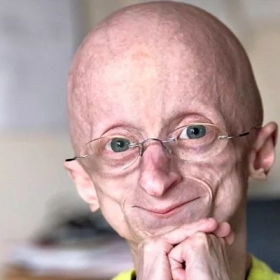 Hội Chứng Progeria Là Gì? Nguyên Nhân, Triệu Chứng Và Hướng Điều Trị Hiện Nay