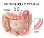 Hội chứng ruột kích thích Hội chứng ruột kích thích