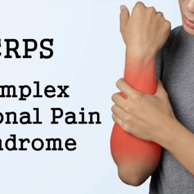 Hội Chứng Sudeck Là Gì? Dấu Hiệu, Mức Độ Nguy Hiểm Và Cách Điều Trị