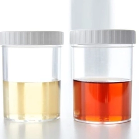 Hồng Cầu Niệu Là Gì? Có Nguy Hiểm Không?