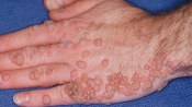 HPV HPV
