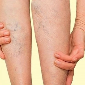 Hướng Dẫn Tư Thế Ngủ Cho Người Suy Giãn Tĩnh Mạch