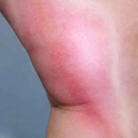 Huyết Khối Tĩnh Mạch Sâu Chi Dưới: Nguyên Nhân, Triệu Chứng Và Cách Điều Trị Hiệu Quả