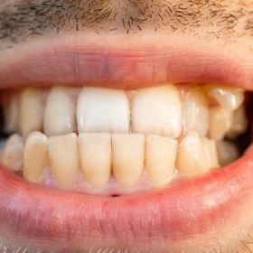 Khớp Cắn Chéo Là Gì? Nguyên Nhân, Dấu Hiệu Và Cách Điều Trị