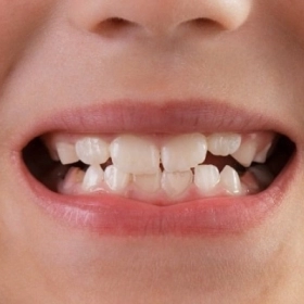 Khớp Cắn Chuẩn Là Gì? Tiêu Chuẩn Khớp Cắn Lý Tưởng