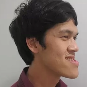 Khớp Cắn Ngược: Nguyên Nhân, Dấu Hiệu Và Cách Điều Trị