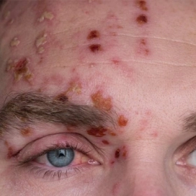 Dùng lá cây chữa zona thần kinh có hiệu quả không? Cách dùng đúng