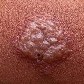 Lao Da Là Gì? Nguyên Nhân, Triệu Chứng, Phân Loại Và Cách Điều Trị