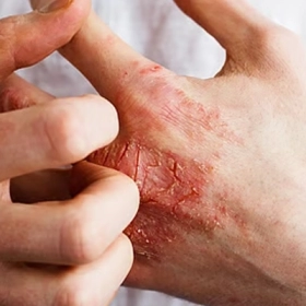 Lebrikizumab Là Gì? Công Dụng Và Cách Sử Dụng Trong Điều Trị Viêm Da Cơ Địa