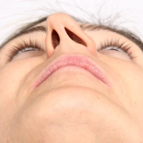 Lệch Vách Ngăn Mũi Có Nguy Hiểm Không? Khi Nào Cần Phẫu Thuật?