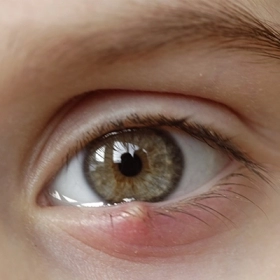 Lẹo Mắt Bao Lâu Thì Khỏi? 7 Cách Làm Lẹo Xẹp Nhanh Tại Nhà