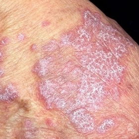 Lichen Phẳng Là Gì? Nguyên Nhân, Triệu Chứng Và Phương Pháp Điều Trị