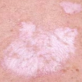 Lichen Xơ Hóa Là Gì? Nguyên Nhân, Triệu Chứng Và Phương Pháp Điều Trị