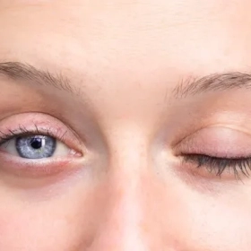 Liệt dây thần kinh số 3: Nguyên nhân, triệu chứng và điều trị