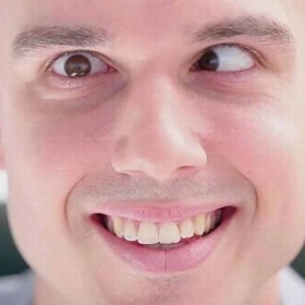 Liệt dây thần kinh số 4 là gì? Nguyên nhân và cách điều trị