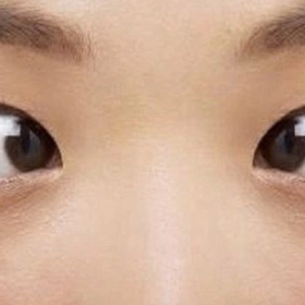 Liệt dây thần kinh số 6: Nguyên nhân, dấu hiệu và cách xử lý