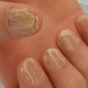 Loạn dưỡng móng: Nguyên nhân, dấu hiệu và cách điều trị