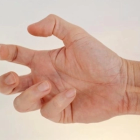 Loạn trương lực cơ là gì? Nguyên nhân, triệu chứng và cách điều trị