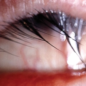 Lông Quặm Ở Mắt: Nguyên Nhân, Triệu Chứng và Cách Điều Trị