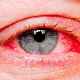 Mắt Bị Ngứa Phải Làm Sao? Cách Giảm Ngứa Mắt Hiệu Quả Tại Nhà