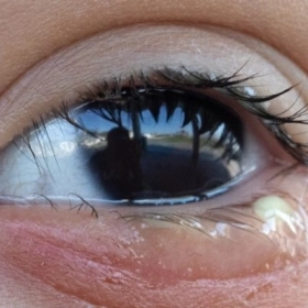 Mắt Đổ Ghèn Nhiều Có Nguy Hiểm Không? Dấu Hiệu Không Nên Chủ Quan