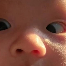 Mắt Lác Ở Trẻ Sơ Sinh Có Bình Thường Không? Khi Nào Cần Lo Lắng